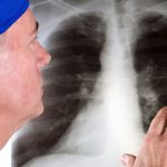 Рак легкого у женщин прогрессирует в Новосибирской области