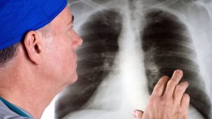 Рак легкого у женщин прогрессирует в Новосибирской области